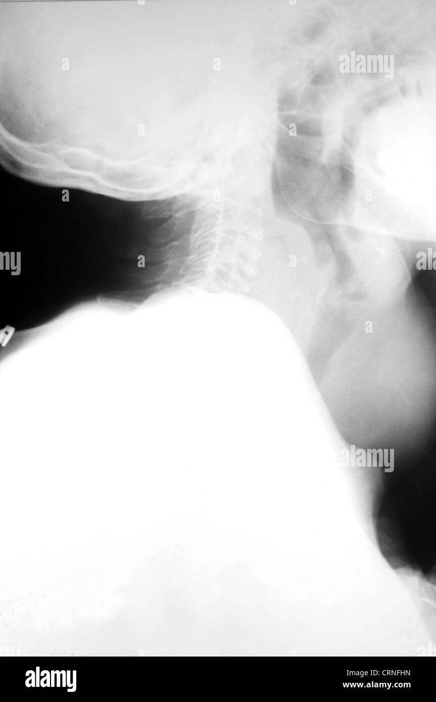 X-ray of upper body. enlarged gland Stock Photo
