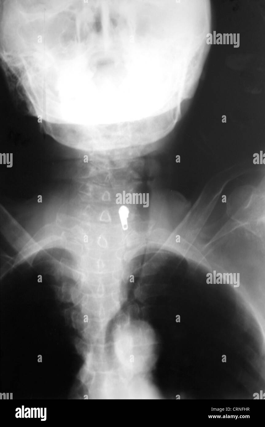 xray of upper body with enlarged thyroid gland Stock Photo
