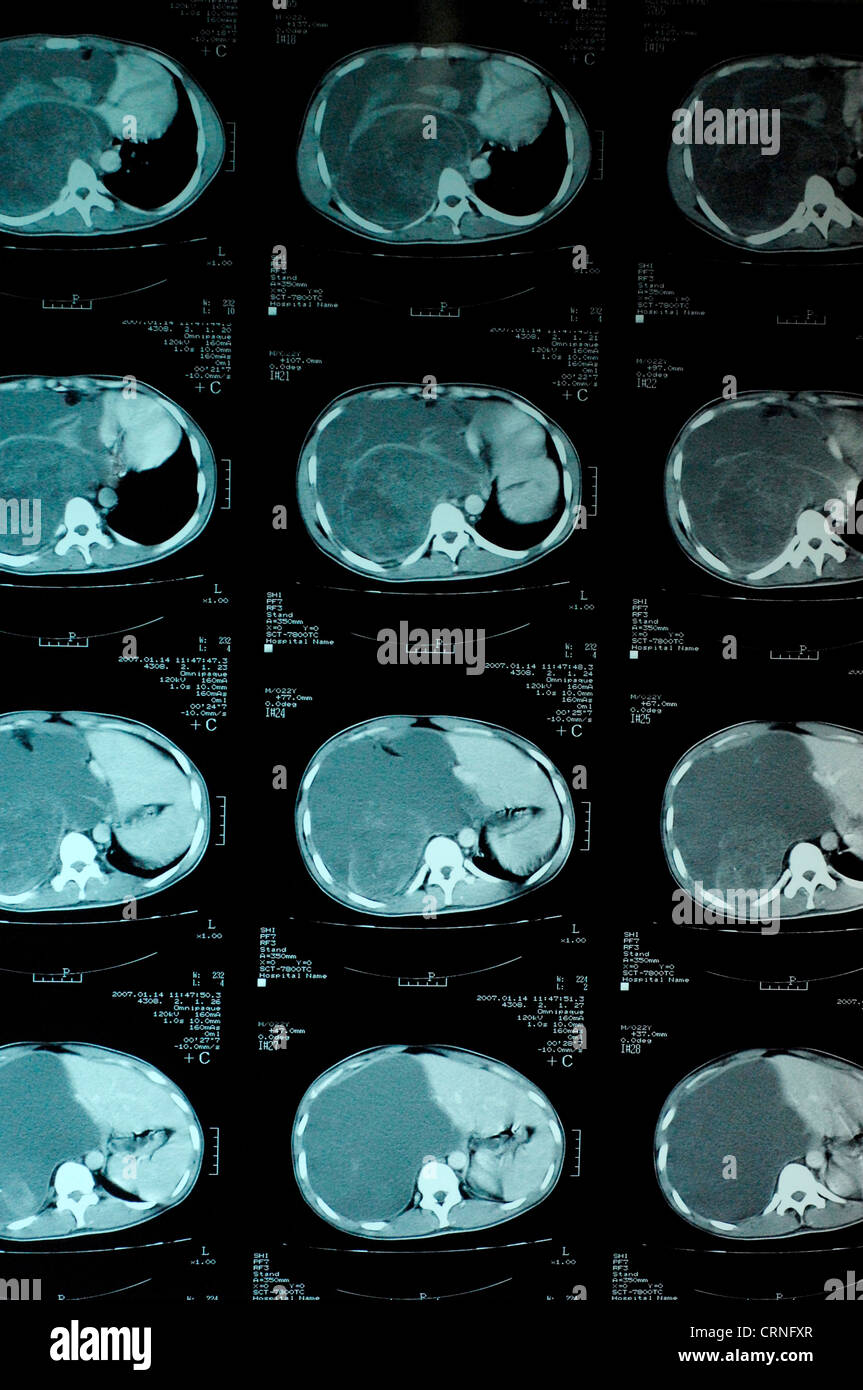 A CT scan showing blood pooling on the right side of a patient's abdomen following recent trauma. Stock Photo