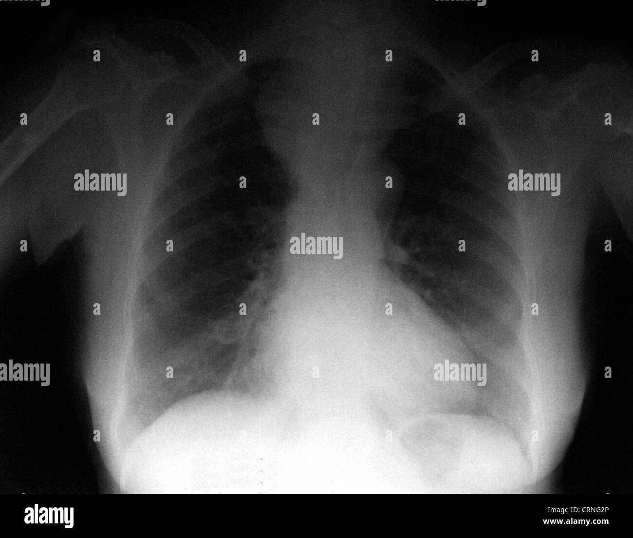 A Post-surgical x-ray of a patient with haemothorax. Stock Photo