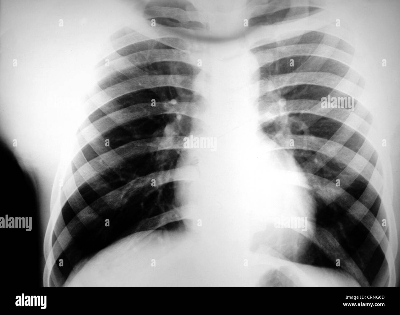 A chest xray revealing a large density in the right part of the chest