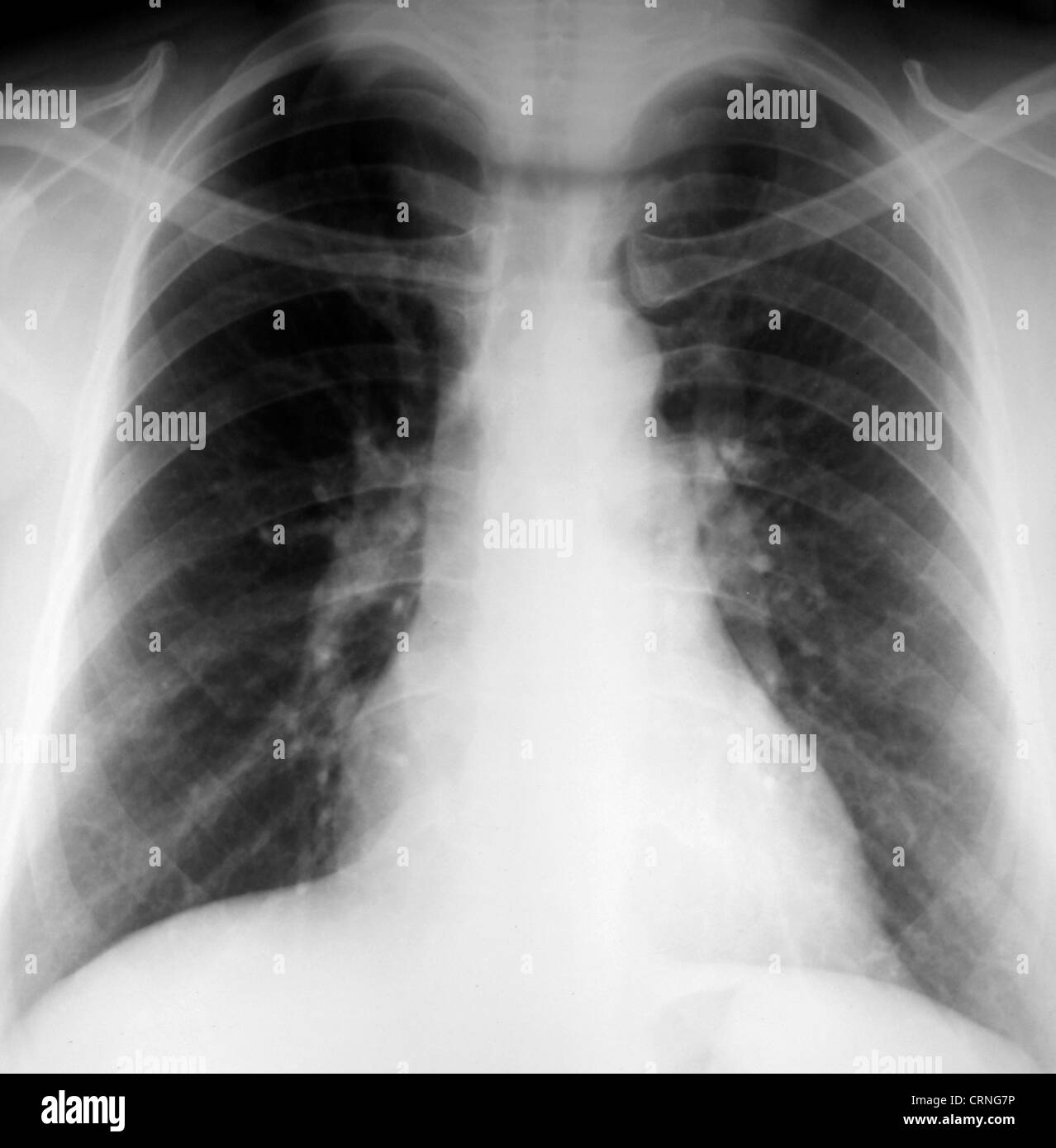 xray of patents upper body, lungs and ribs Stock Photo - Alamy