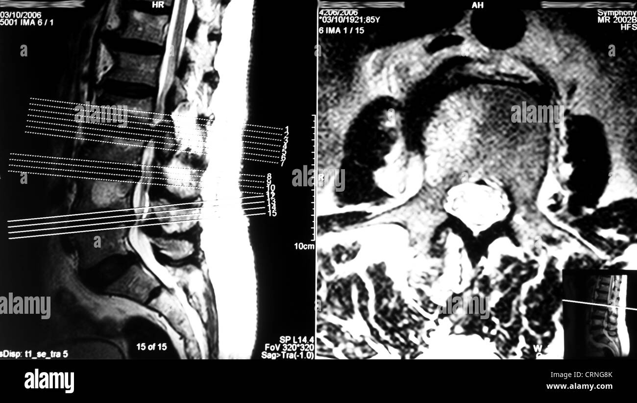 A Magnetic Resonance Imaging (MRI) scan showing evidence of degenerative disc disease and spinal stenosis. The discs between lumber vertebraes L2-L5 are clearly bulging out, with the disc between L2 and L3 showing significant herniation onto the spinal cord. The collagen II-based centre of the intervertebral discs is known as the nucleus pulpo Stock Photo