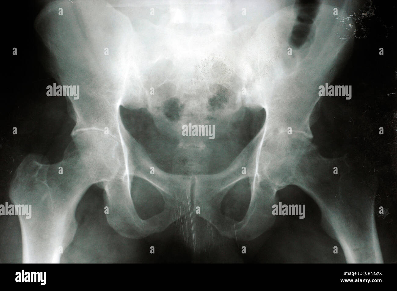 X-ray of a humans pelvis Stock Photo