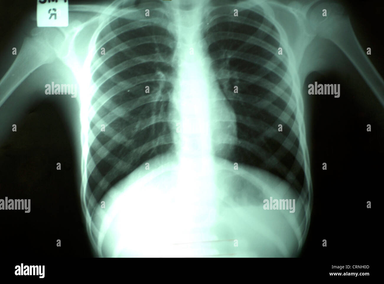 Chest x-ray. Stock Photo