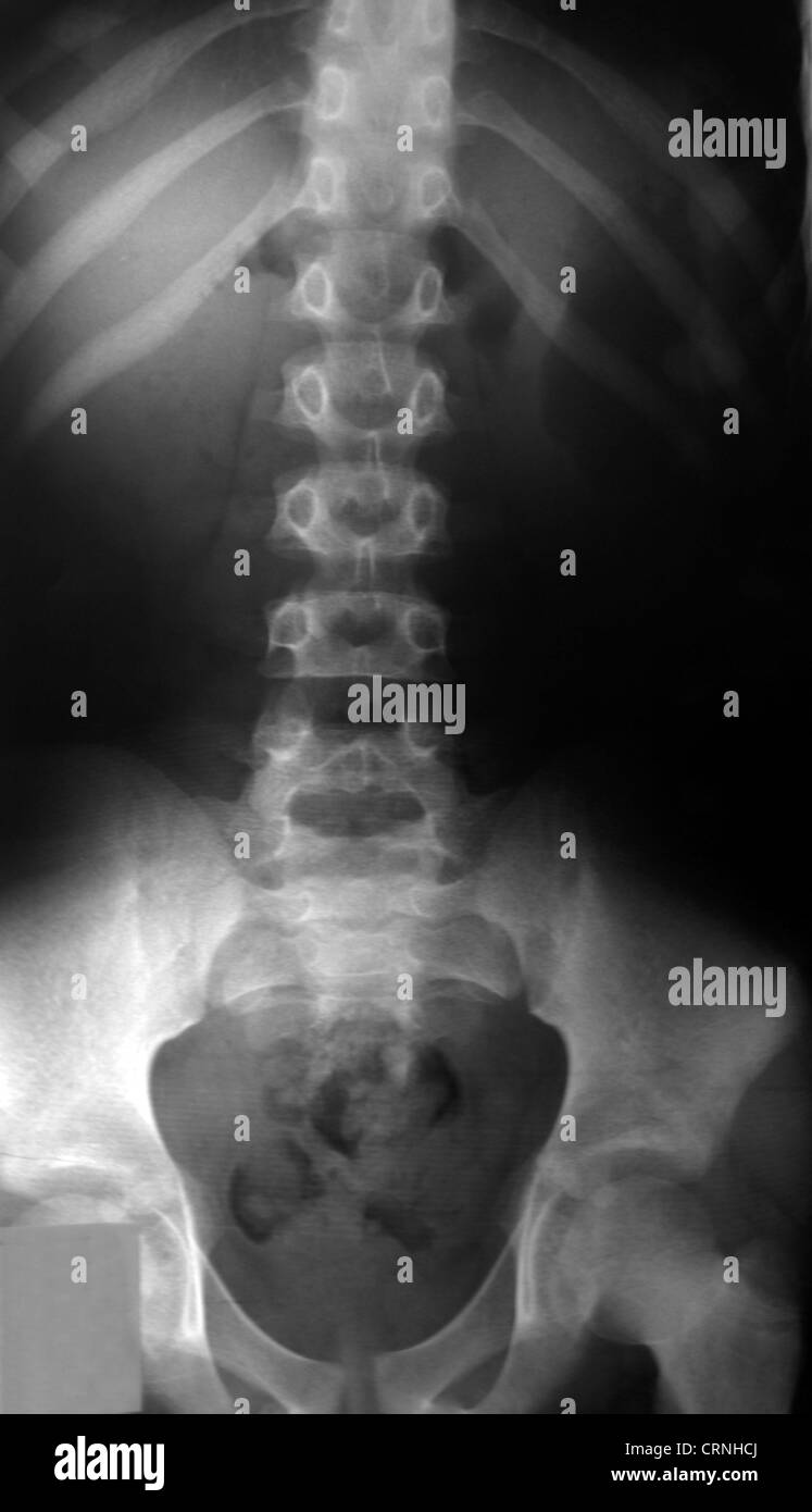 An abdominal x-ray Stock Photo