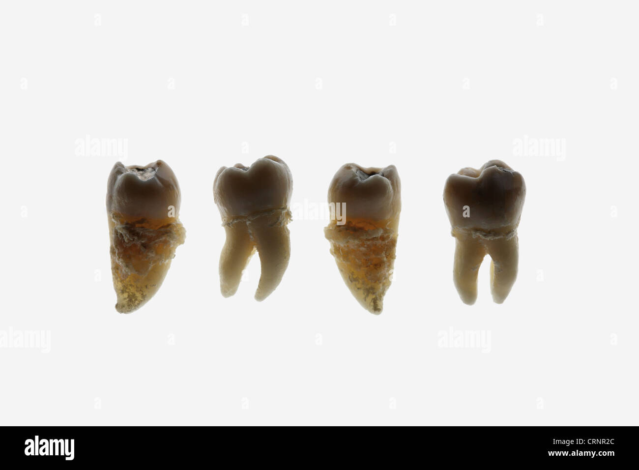 Four extracted human teeth on white background Stock Photo
