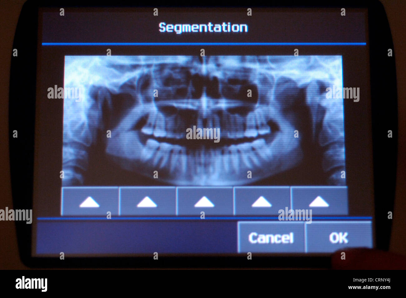 An x-ray image of a human jaw and teeth. Stock Photo