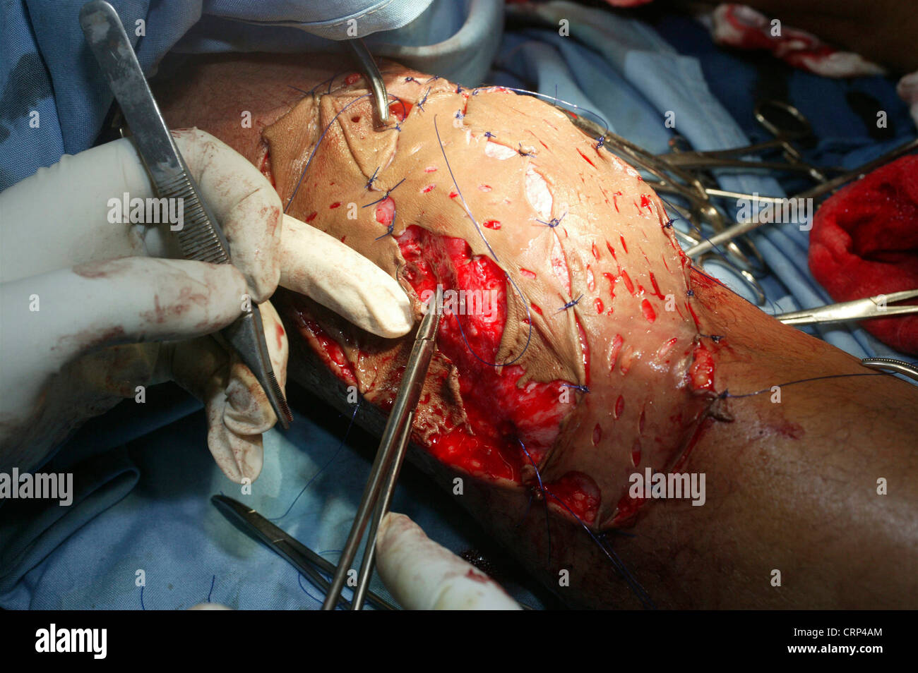 stitching after a operation Stock Photo