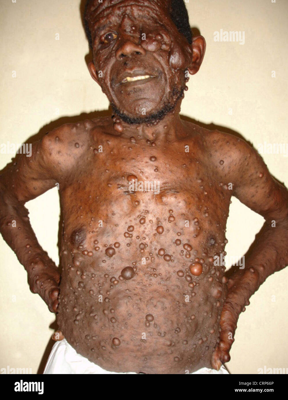 A patient with neurofibromatosis. Stock Photo
