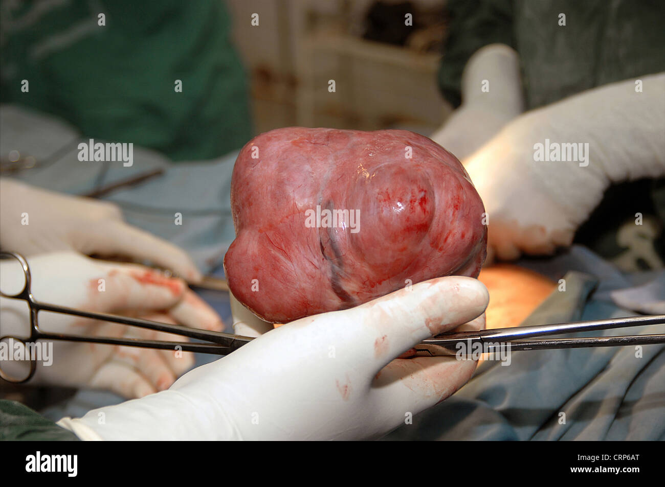 A gloved hand holds a surgically removed fibroid. Stock Photo