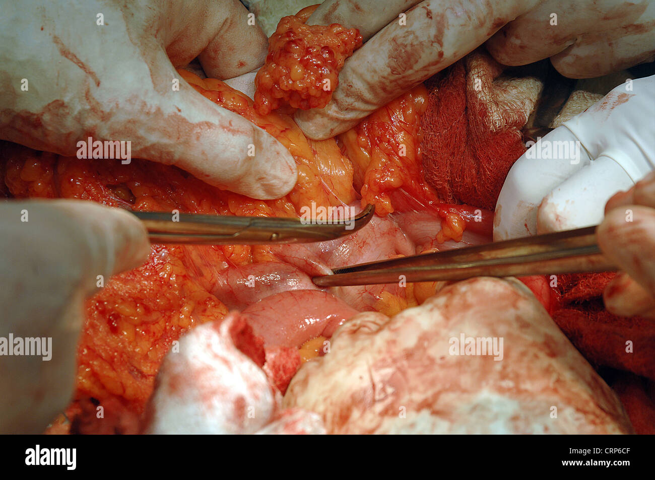 An operation in which the benign tumours (fibroids) are removed from the lining of the uterus. Stock Photo