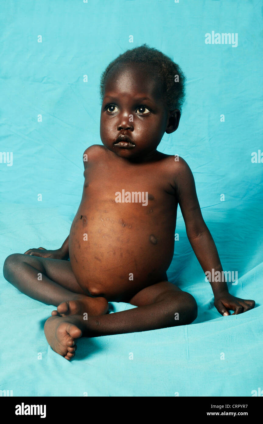 A 2 year old boy suffering from abdominal distencion 3 months - hepatosplenomegaly Stock Photo