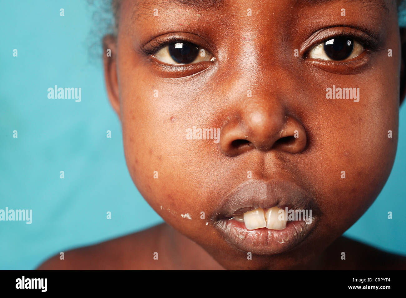 Close up the face of a 12 year old girl suffering from nephrotic syndrome and sickle cell anemia. Stock Photo