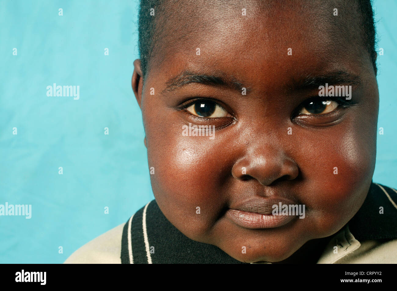 A child with Nephritic Syndrome Stock Photo