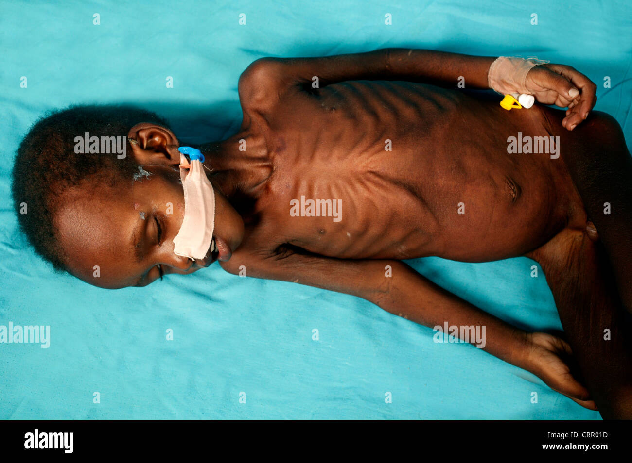 A 2 year old boy suffering from serious malnutrition with severe wastening and loss of subcutaneous fat. Stock Photo