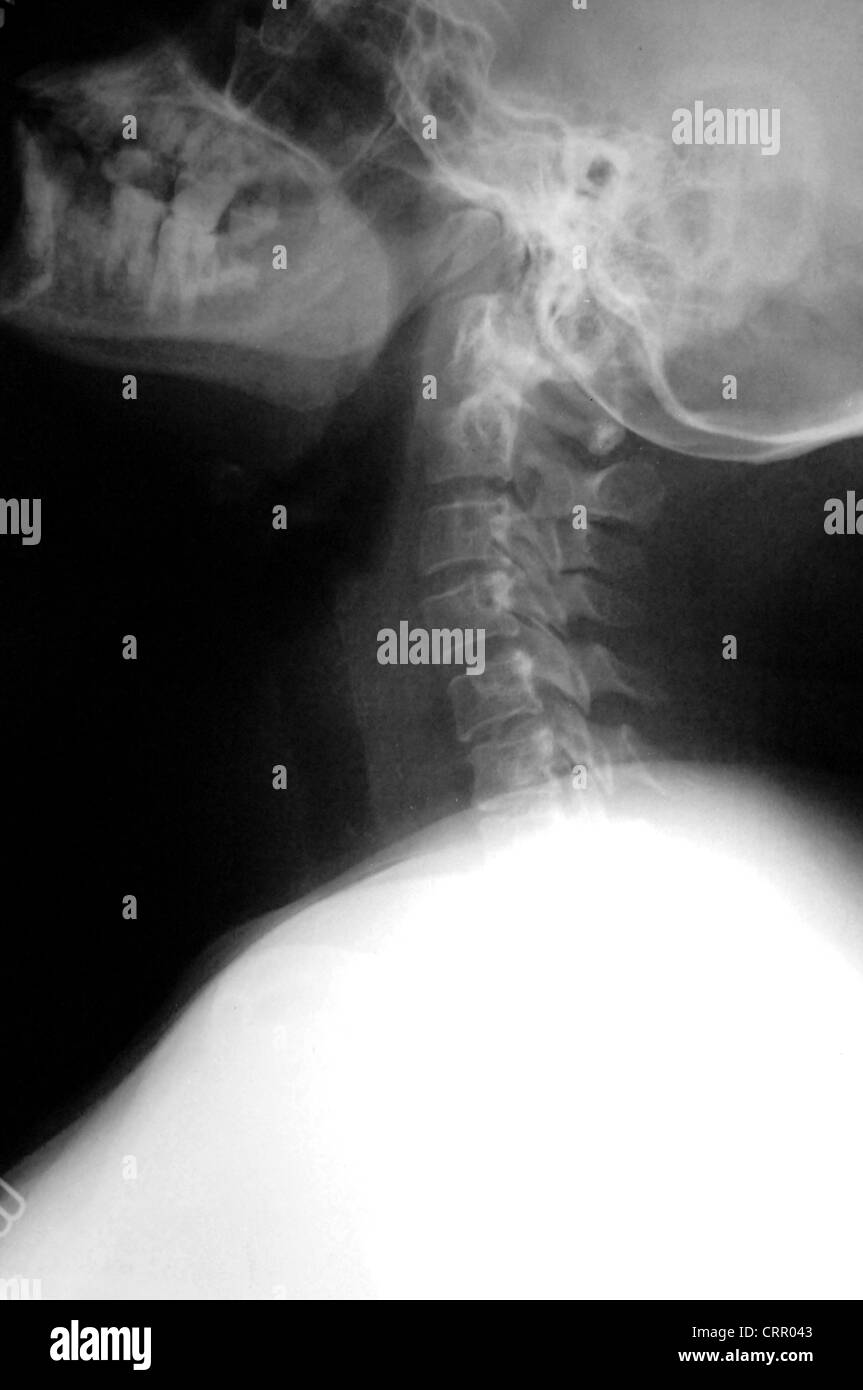 Plain neck x-ray with neck at full extension. Stock Photo