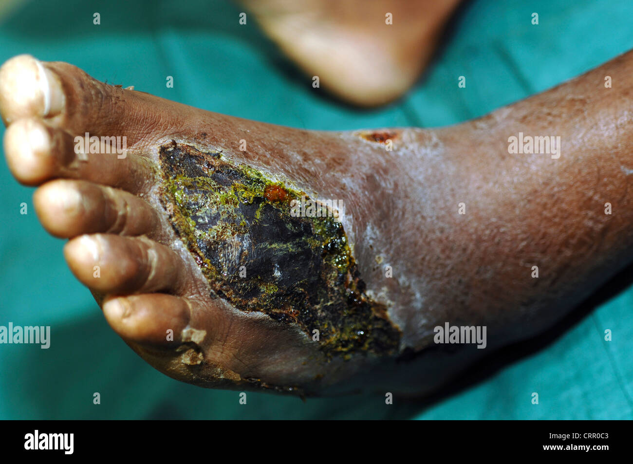 A foot with cell decay Stock Photo