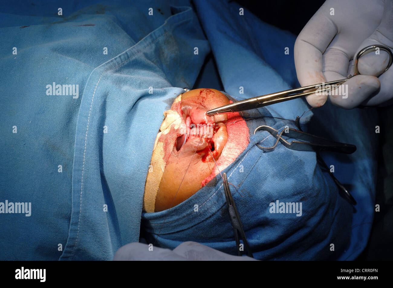 Baby cleft palate operation. A second suture is placed in the repaired cleft lip of a child during surgery Stock Photo