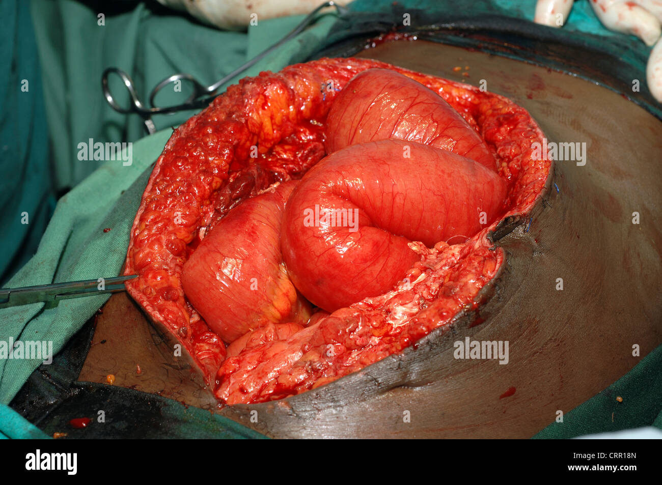 Surgeons work to remove the caecum and ascending colon of a patient following a gunshot wound. Stock Photo