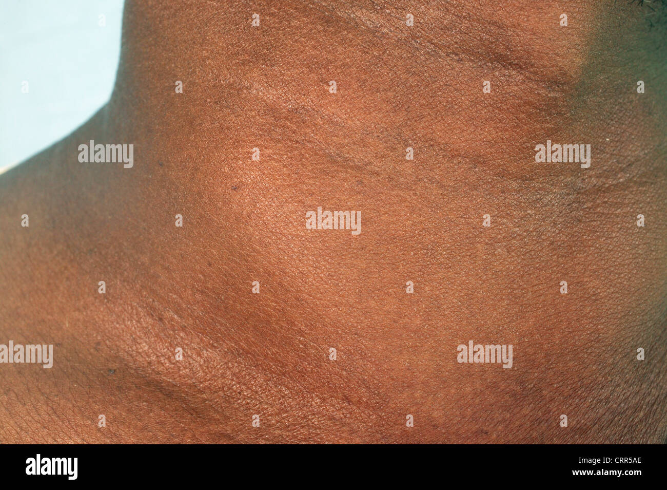 Man with Deficiency Diet and Enlarged Gland Stock Photo