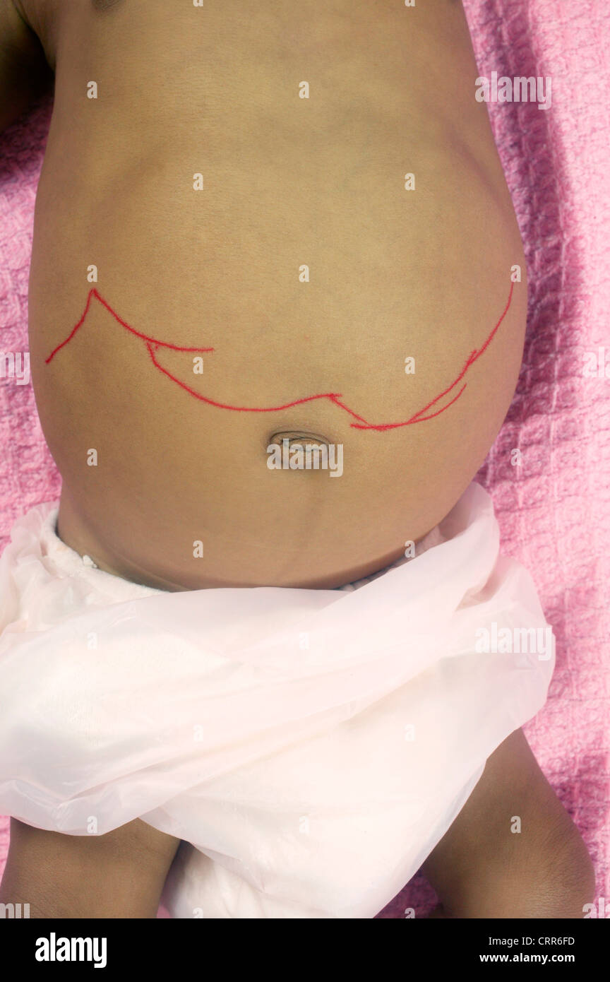 A line drawn by a surgeon on a young child awaiting surgery. Stock Photo