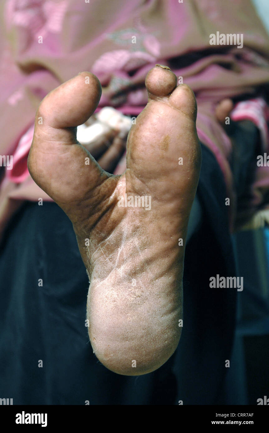 Close up of a left foot with second, third and fourth toes amputated. Stock Photo
