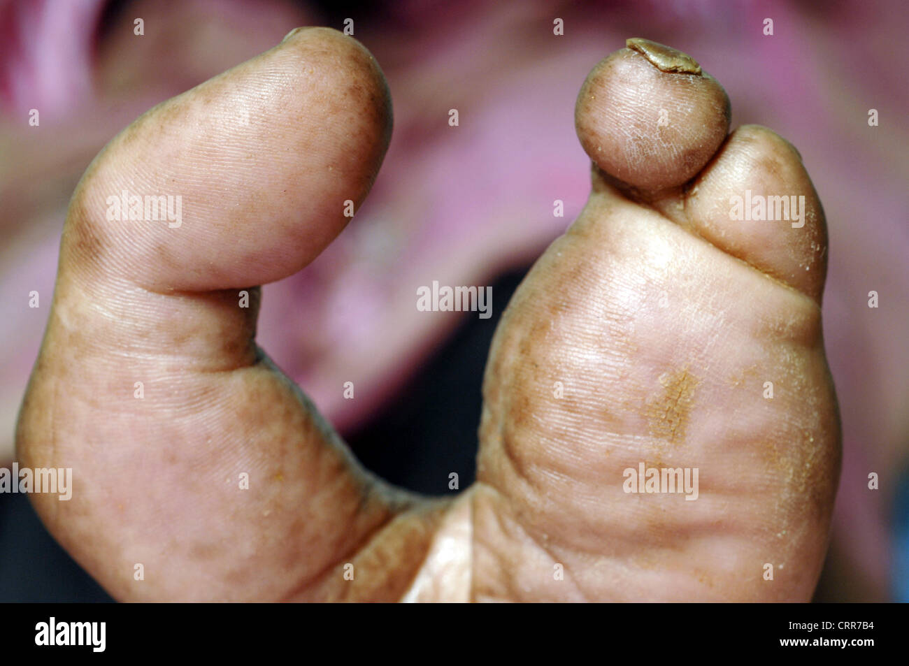 Close up of a left foot with second, third and fourth toes amputated. Stock Photo