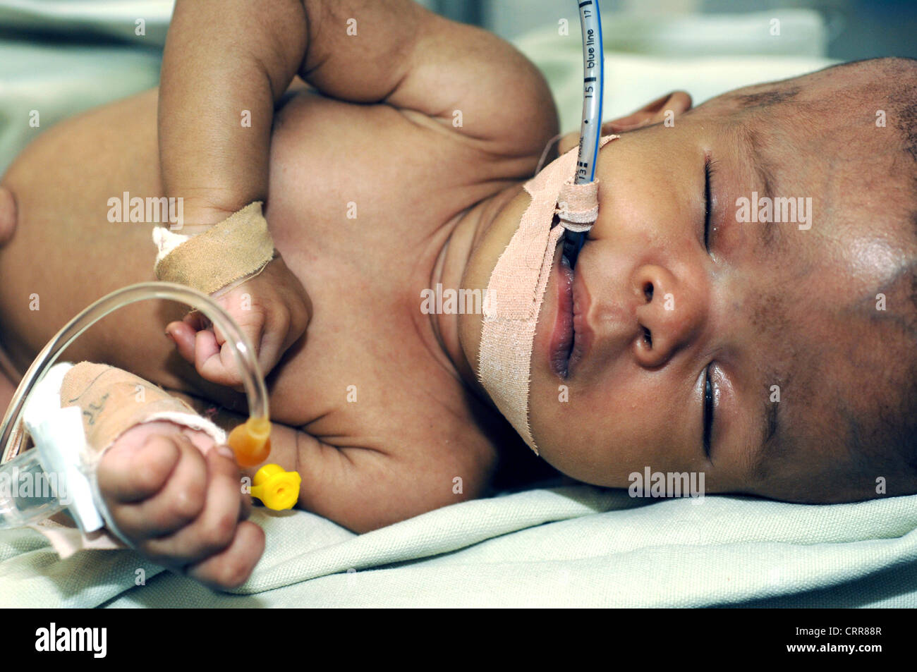 A baby during surgery Stock Photo