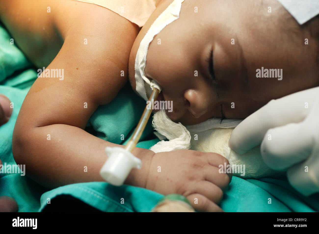 Baby breathing through Endotracheal tube Stock Photo