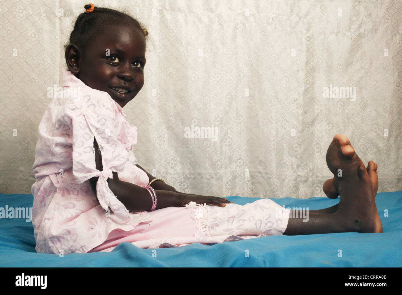 A 6 year old girl with an enlarged right foot. Cause unknown. Stock Photo