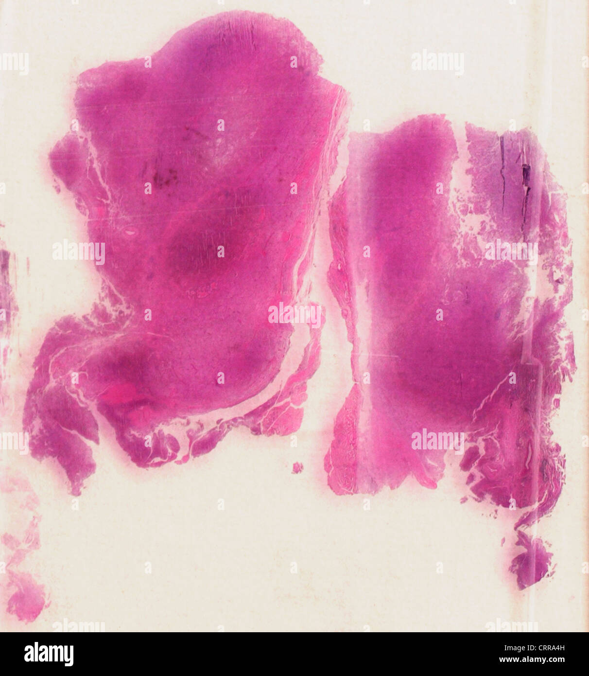 Cytology slide showing malignant melanoma. Stock Photo