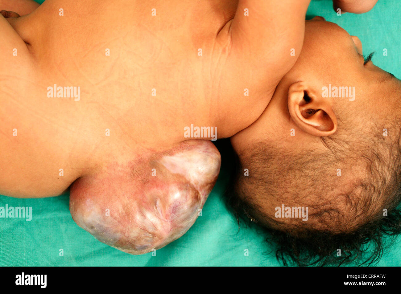 The spine of a male infant of 5-months with Meningomyocele; a congenital tumour of the spinal canal. Stock Photo
