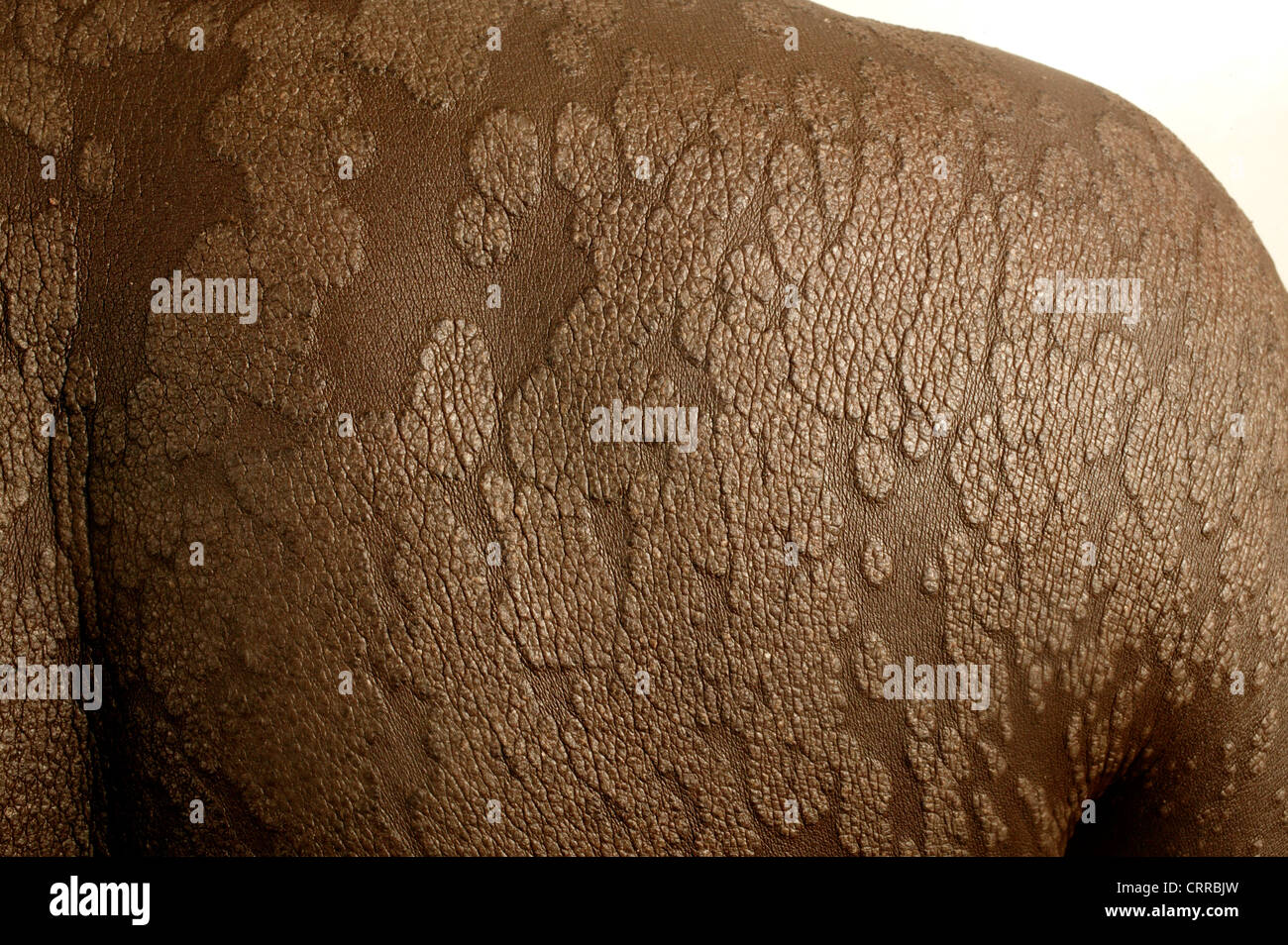 Flaky Back Back Condition Dermatological Stock Photo - Alamy