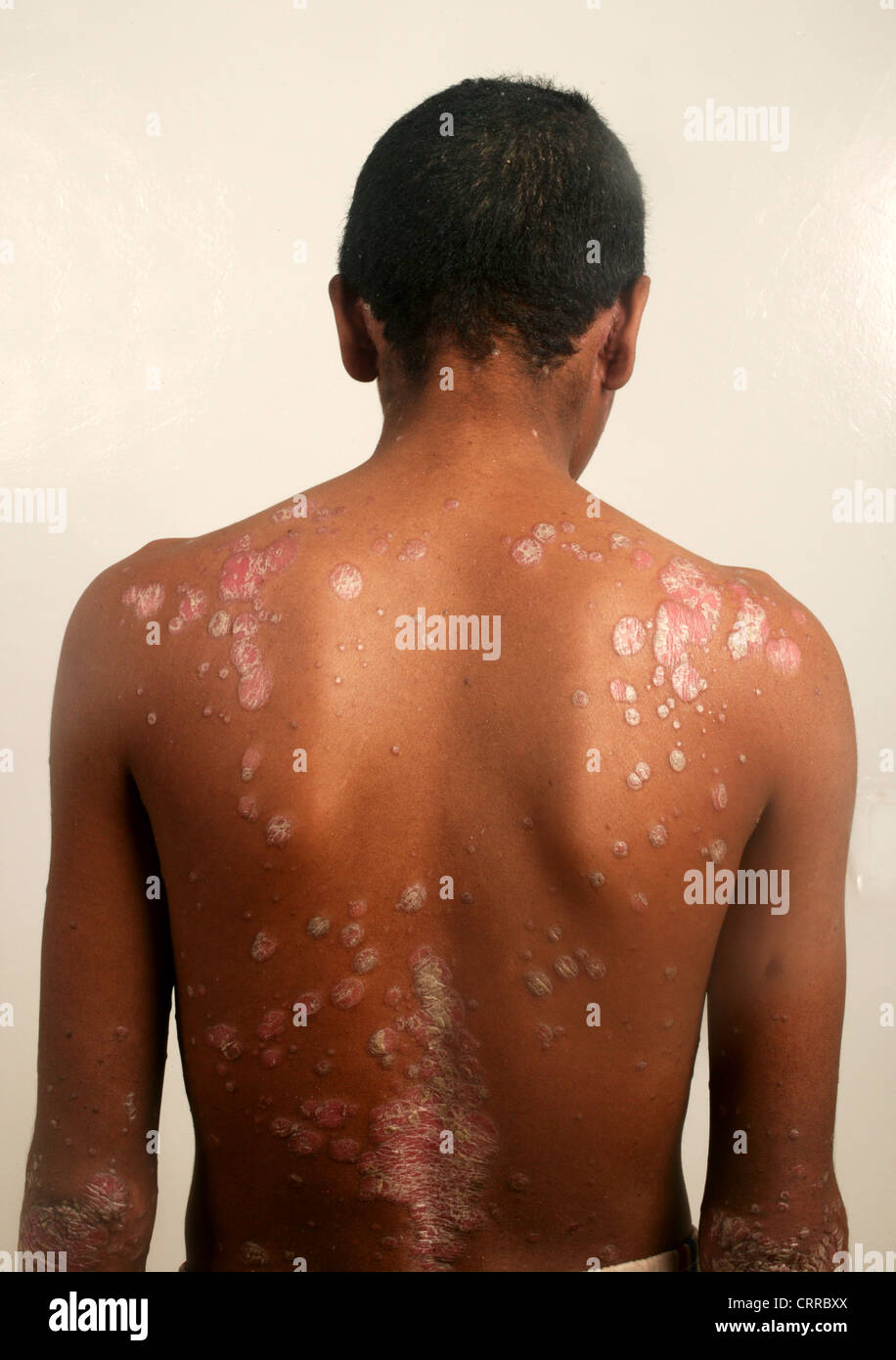 Adolescent Back Condition Stock Photo