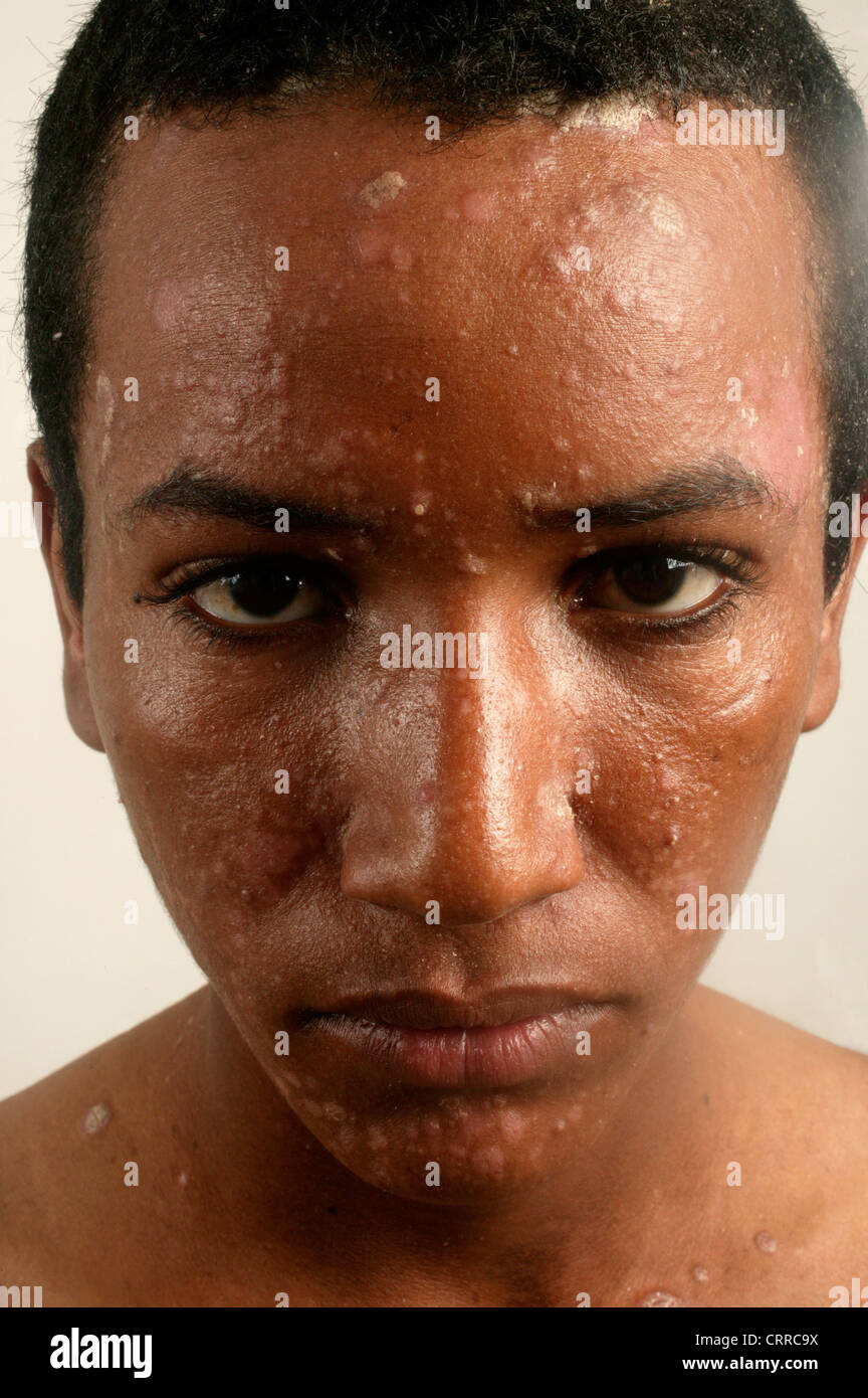 A young man with a fungal skin condition. Stock Photo