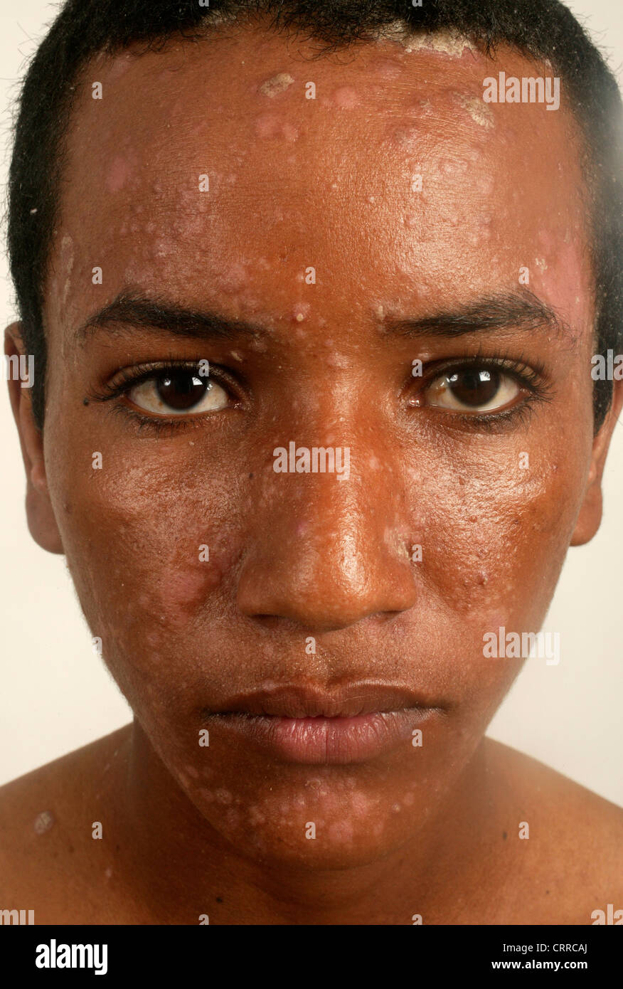 A young man with a fungal skin condition. Stock Photo