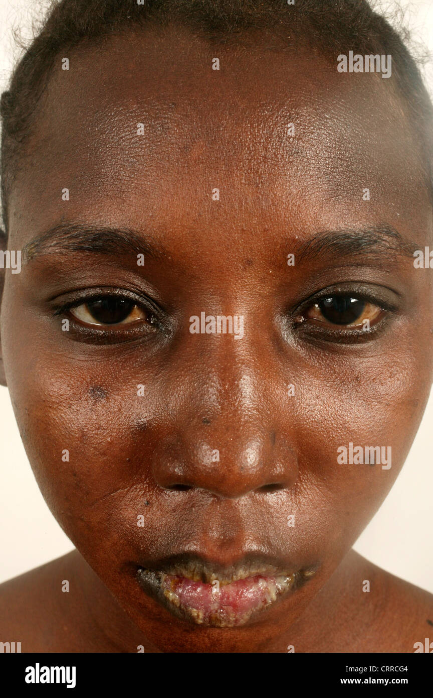 Dry mouth syndrome hires stock photography and images Alamy