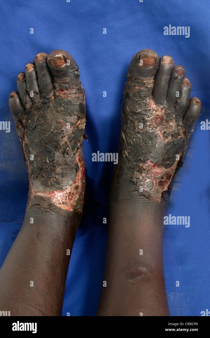 Kaposi's Sarcoma; a skin cancer which is often a manifestation of AIDS. Stock Photo