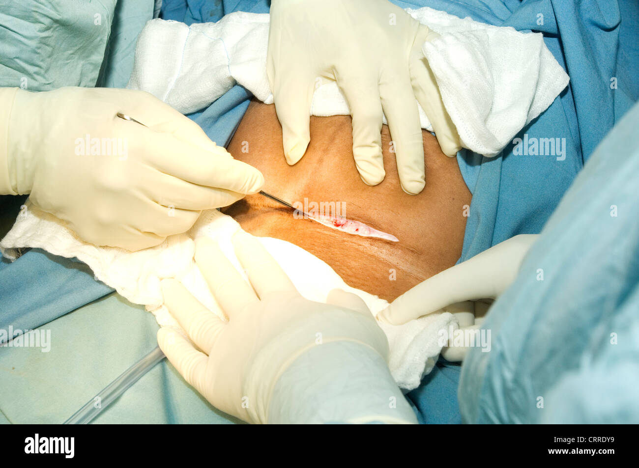 Cesarean Section Child Birth Stock Photo
