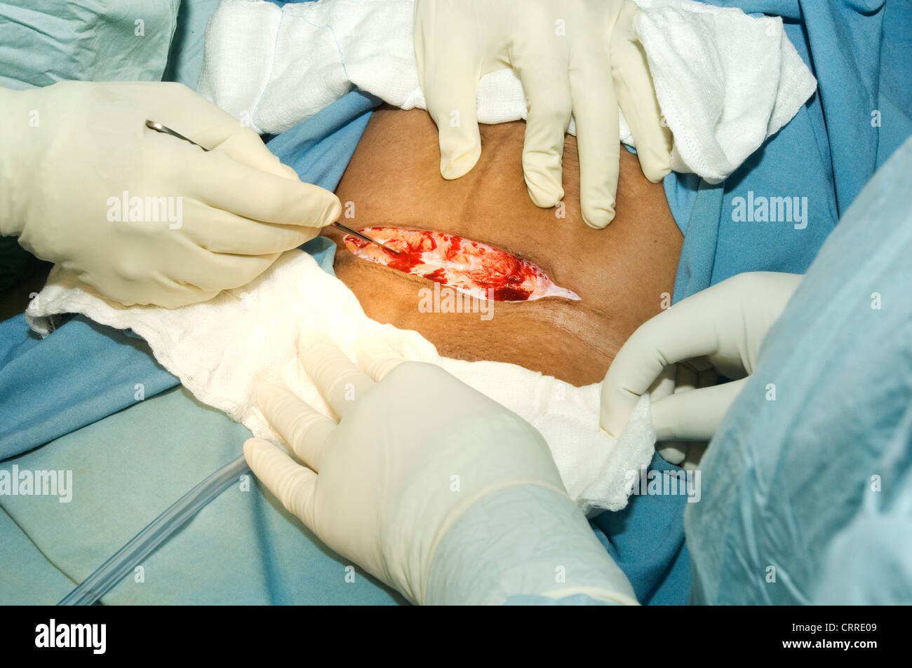 A surgeon uses a scalpel to make the initial incision during a Caesarean delivery. Stock Photo