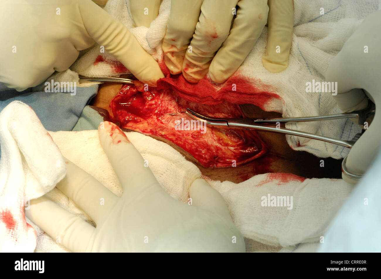 The surgeon prepares to open the abdominal cavity. Stock Photo