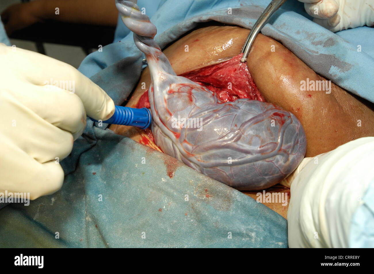 Human placenta, following its removal after a cesarean delivery. Stock Photo