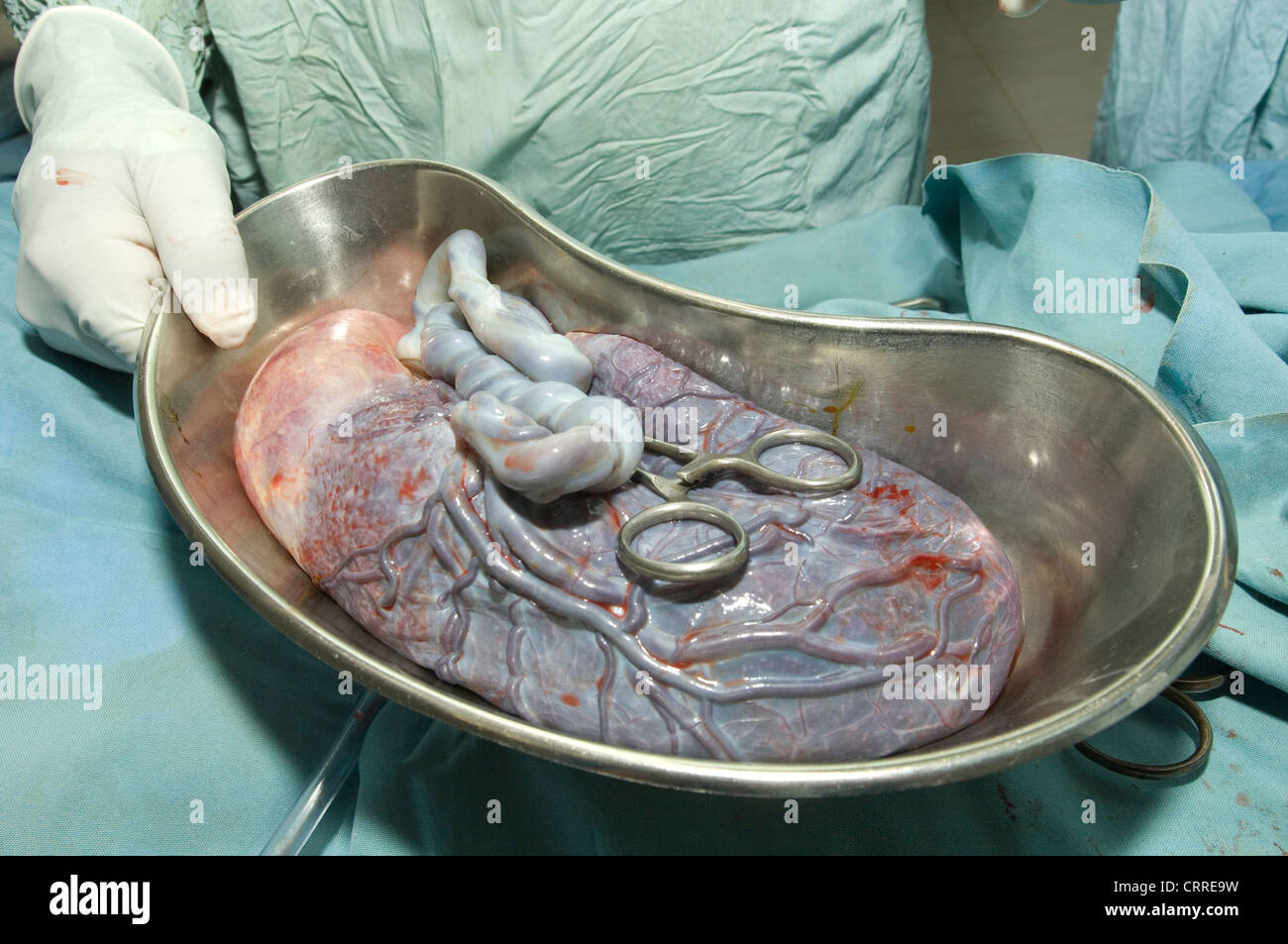 Human placenta in a kidney dish, following its removal after a cesarean delivery. Stock Photo