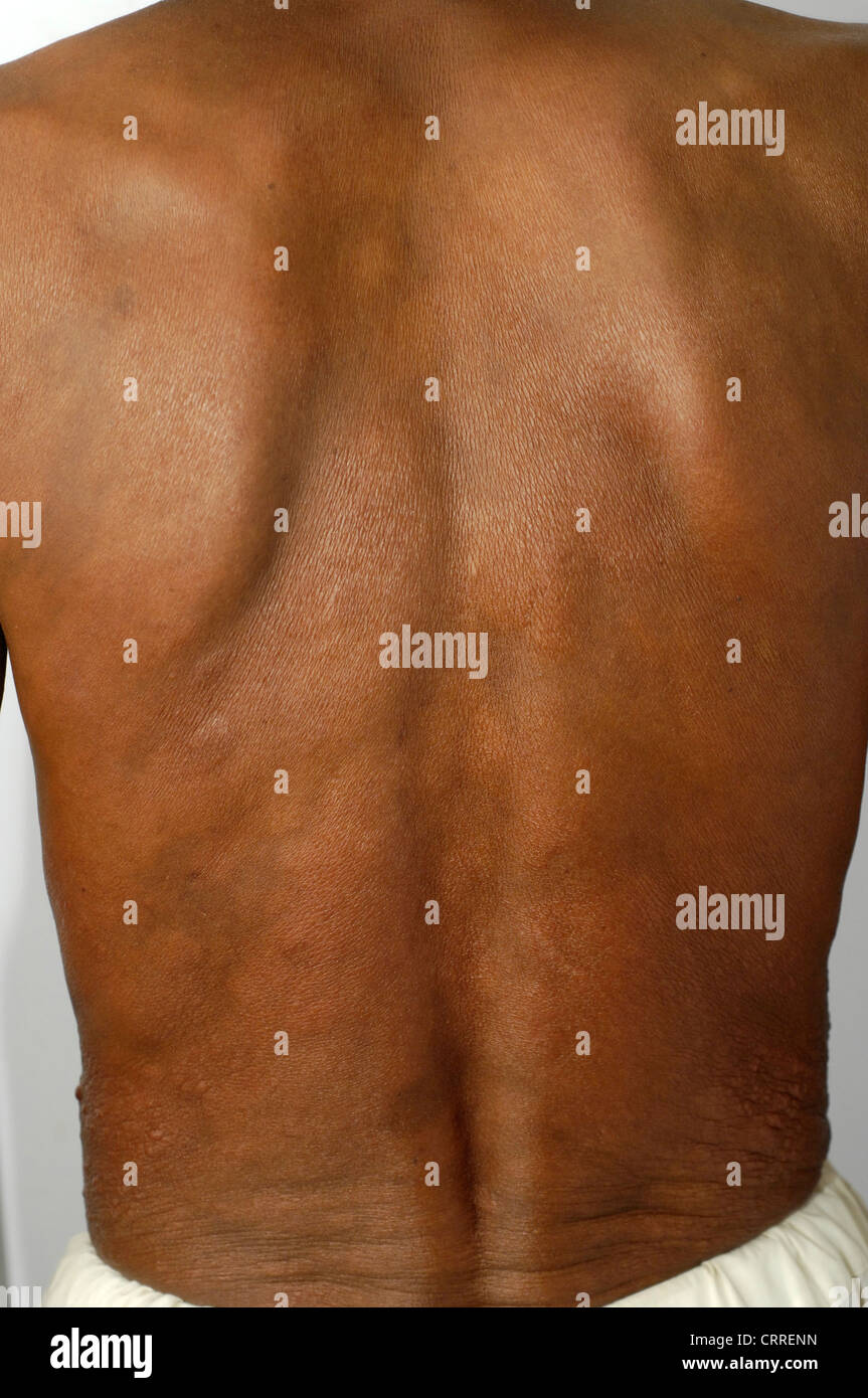 A patient with pityriasis rosea. Stock Photo