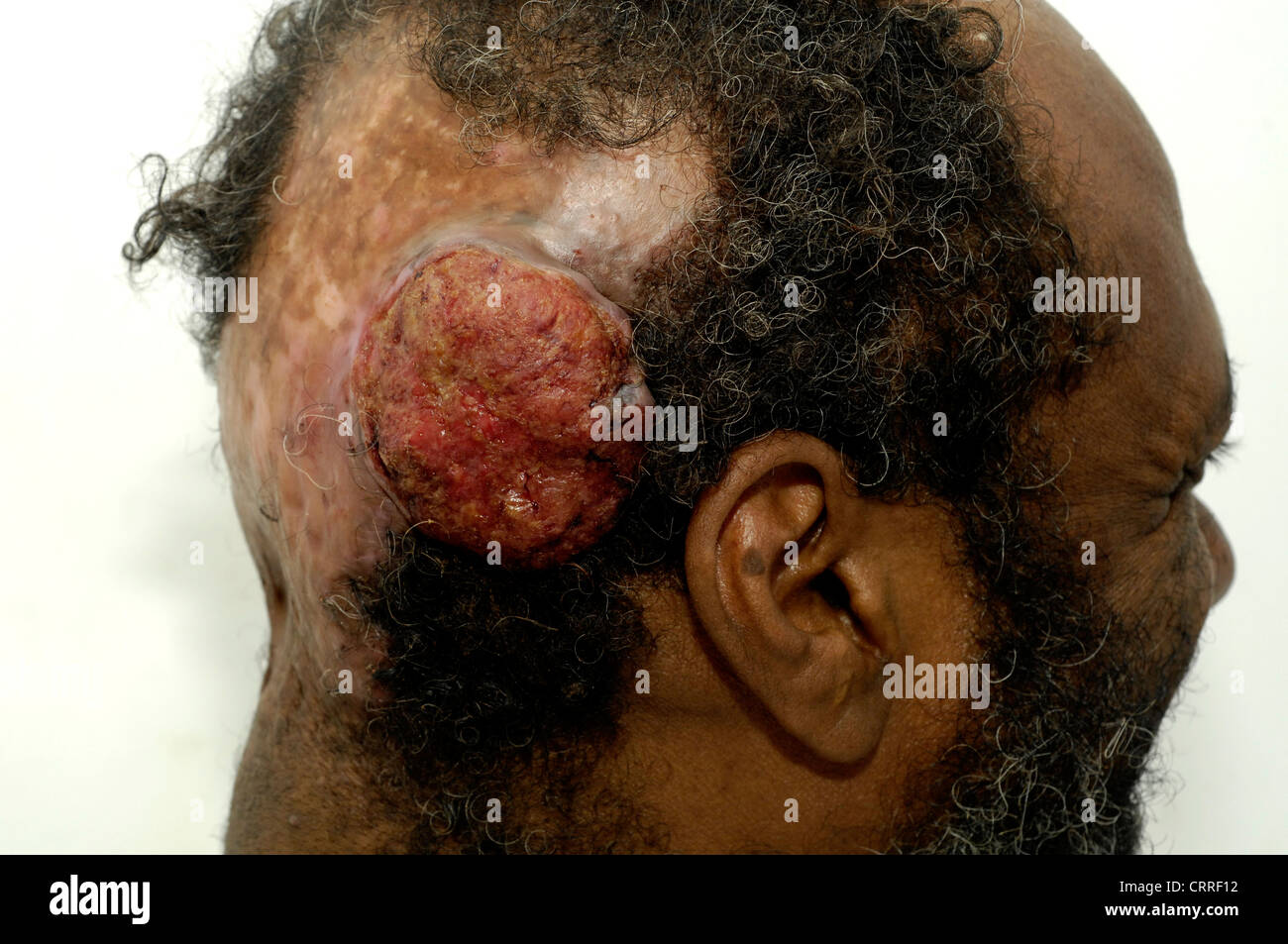 A man with a sebaceous carcinoma of the scalp and accompanying alopecia. Stock Photo
