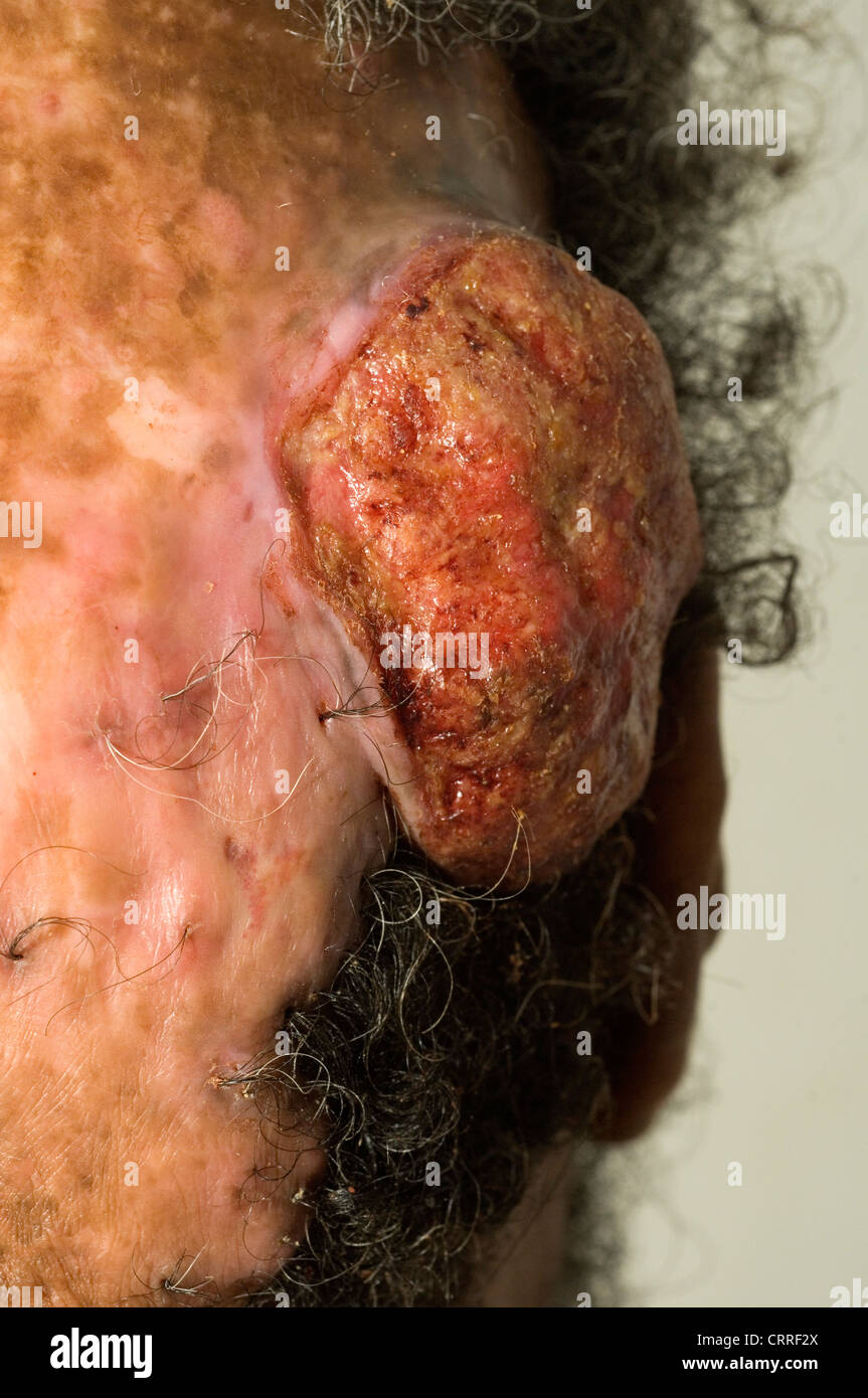 A man with a sebaceous carcinoma of the scalp and accompanying alopecia. Stock Photo