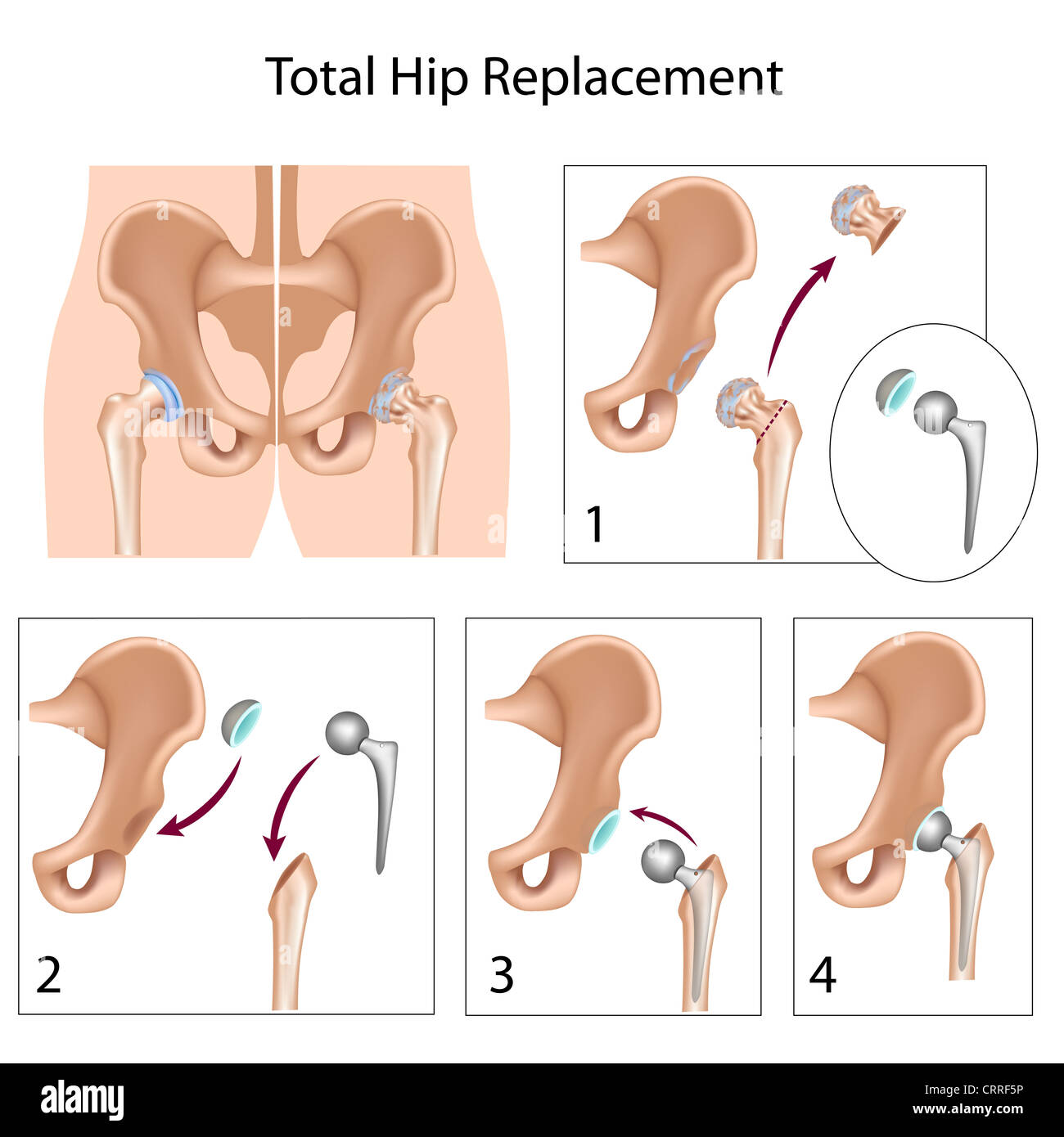 Total hip replacement surgery Stock Photo Alamy