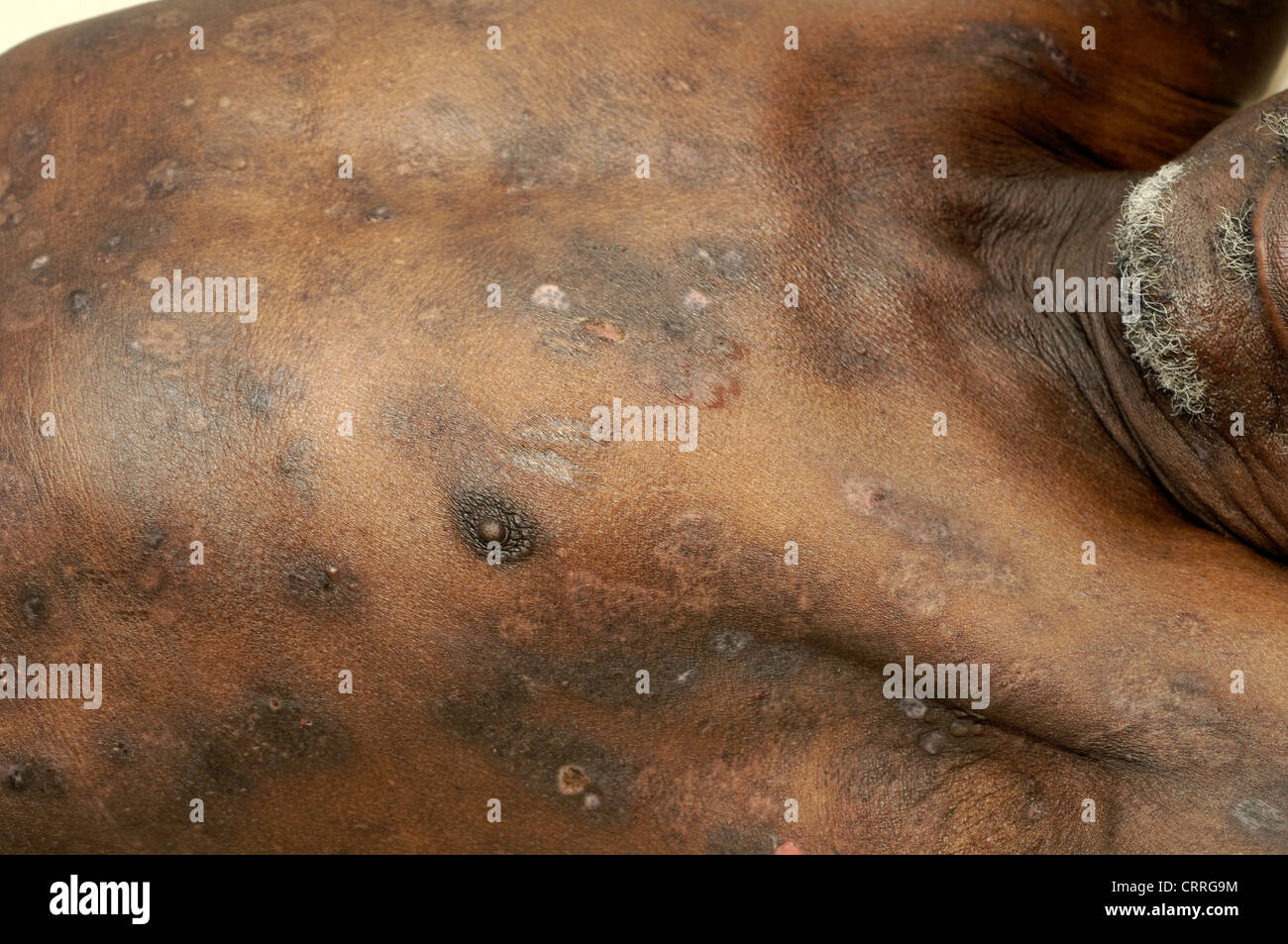 A man with a fungal skin disease. Stock Photo