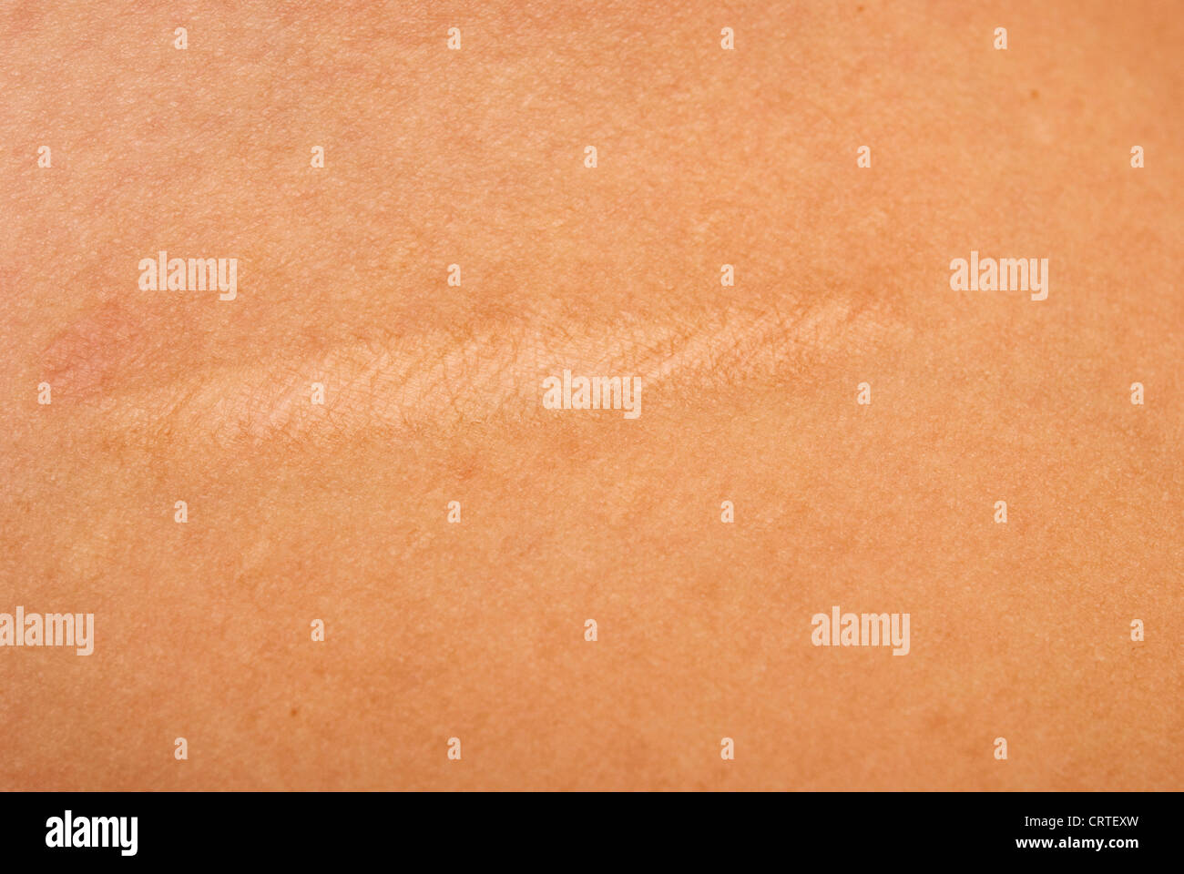 Scab scar hires stock photography and images Alamy